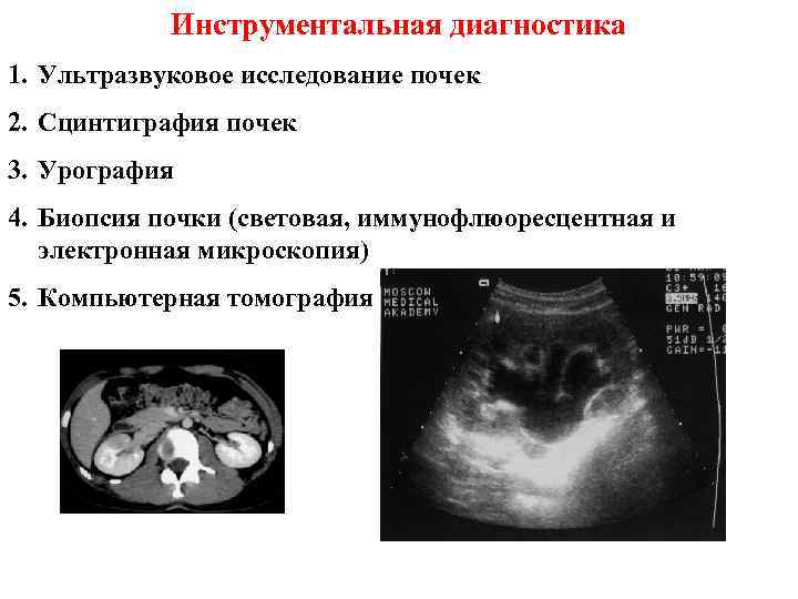 Гломерулонефрит узи картина