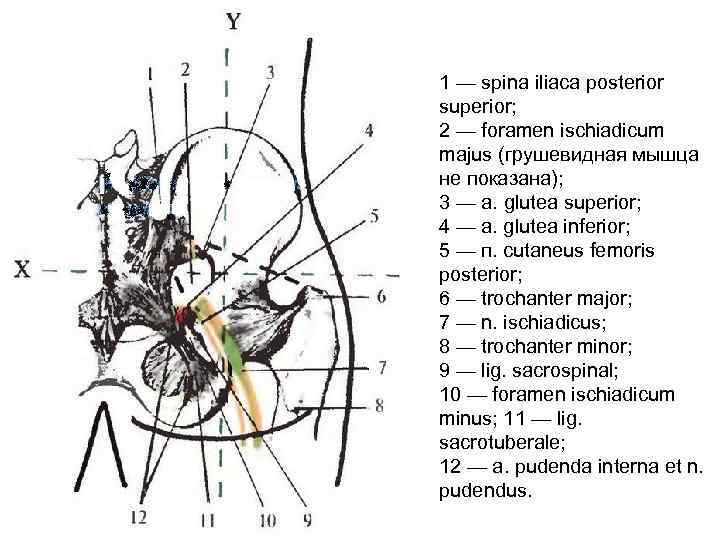 1 — spina iliaca posterior superior; 2 — foramen ischiadicum majus (грушевидная мышца не