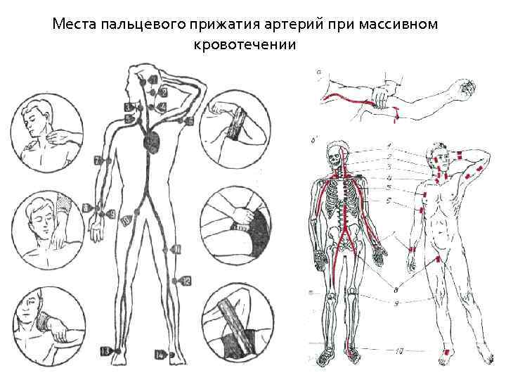 Фото пальцевое прижатие артерии