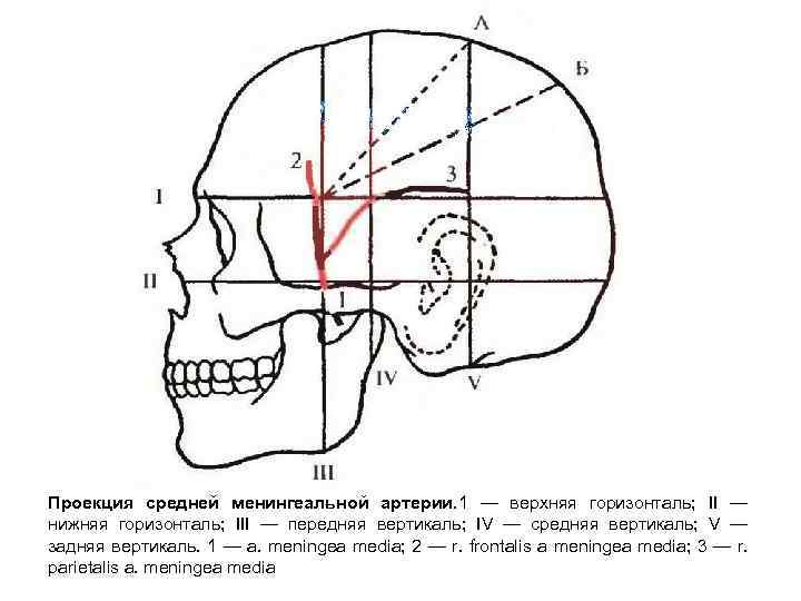 Проекция средней менингеальной артерии. 1 — верхняя горизонталь; II — нижняя горизонталь; III —