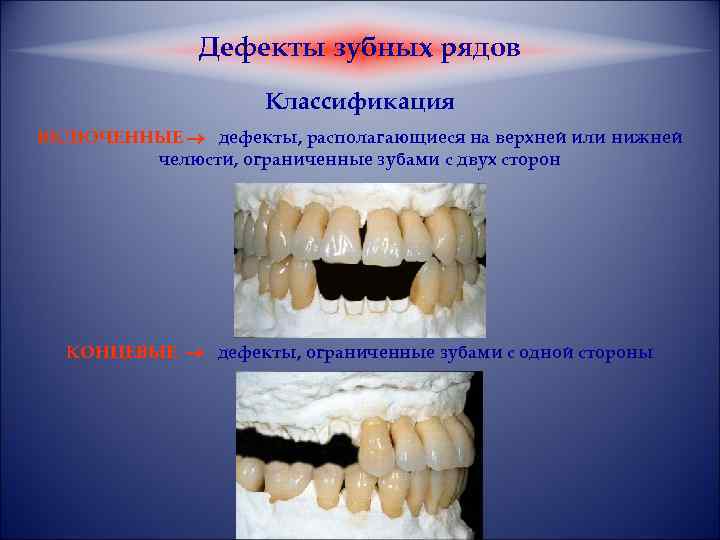 Классификация дефектов зубных рядов