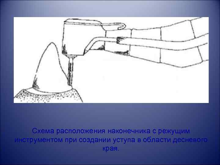 Схема расположения наконечника с режущим инструментом при создании уступа в области десневого края. 
