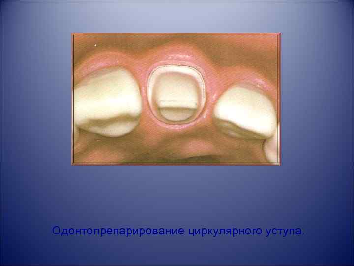 Одонтопрепарирование циркулярного уступа. 