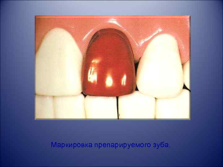 Маркировка препарируемого зуба. 