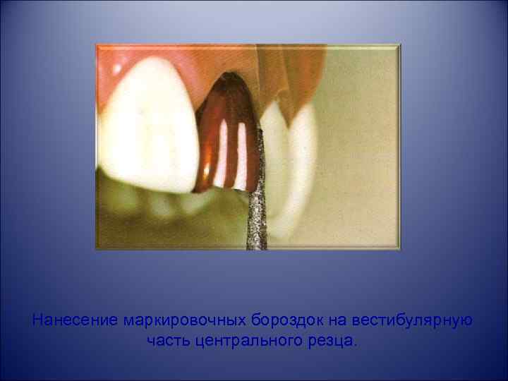 Нанесение маркировочных бороздок на вестибулярную часть центрального резца. 