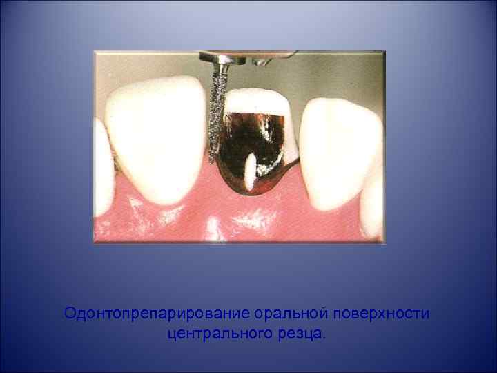 Одонтопрепарирование оральной поверхности центрального резца. 
