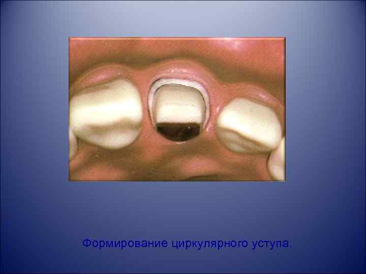 Формирование циркулярного уступа. 