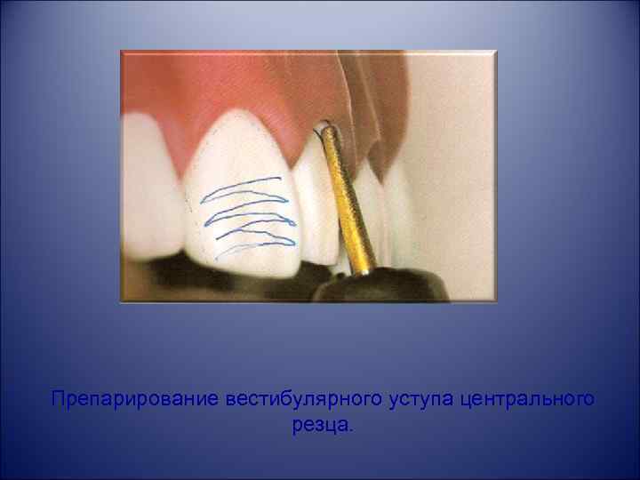Препарирование вестибулярного уступа центрального резца. 