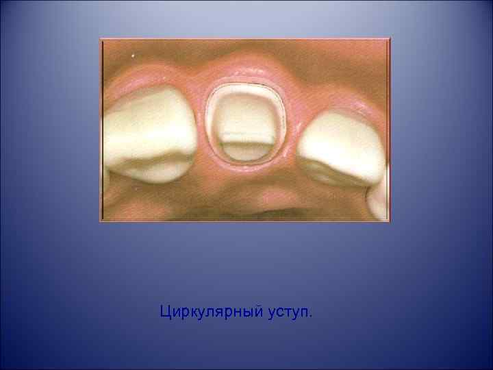 Циркулярный уступ. 