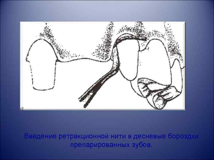 Введение ретракционной нити в десневые бороздки препарированных зубов. 