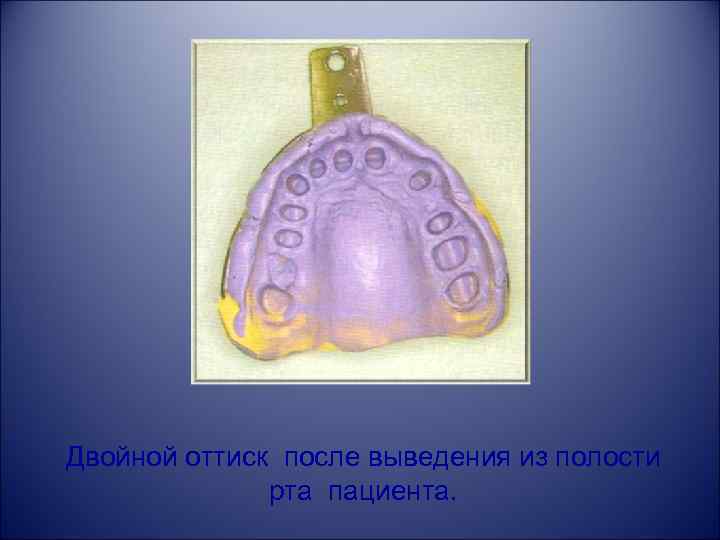 Двойной оттиск после выведения из полости рта пациента. 