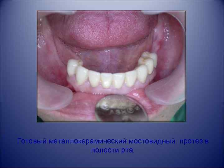 Готовый металлокерамический мостовидный протез в полости рта. 