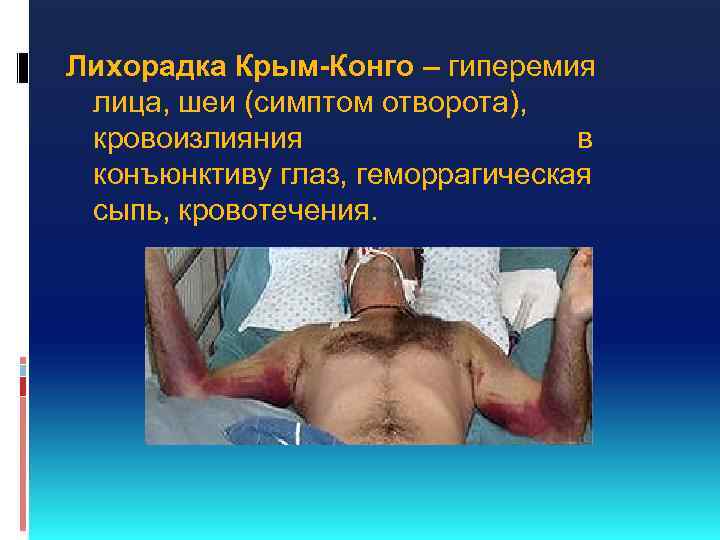 Лихорадка Крым-Конго – гиперемия лица, шеи (симптом отворота), кровоизлияния в конъюнктиву глаз, геморрагическая сыпь,