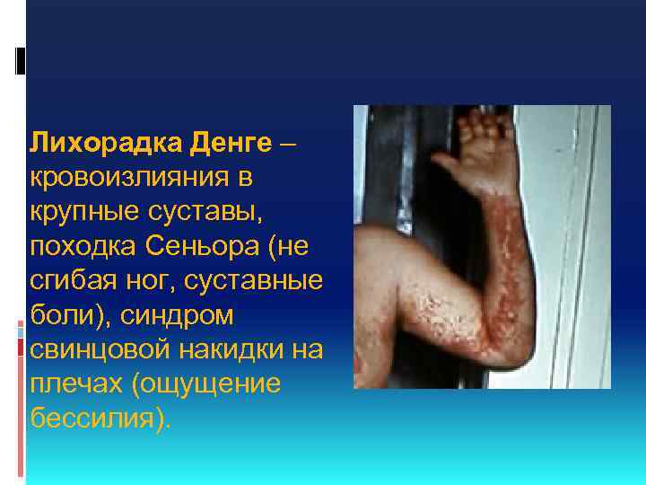 Лихорадка Денге – кровоизлияния в крупные суставы, походка Сеньора (не сгибая ног, суставные боли),