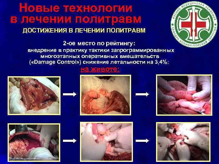 Новые технологии в лечении политравм ДОСТИЖЕНИЯ В ЛЕЧЕНИИ ПОЛИТРАВМ 2 -ое место по рейтингу:
