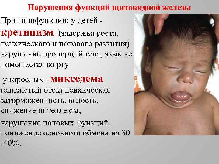 Нарушения функций щитовидной железы При гипофункции: у детей - кретинизм (задержка роста, психического и
