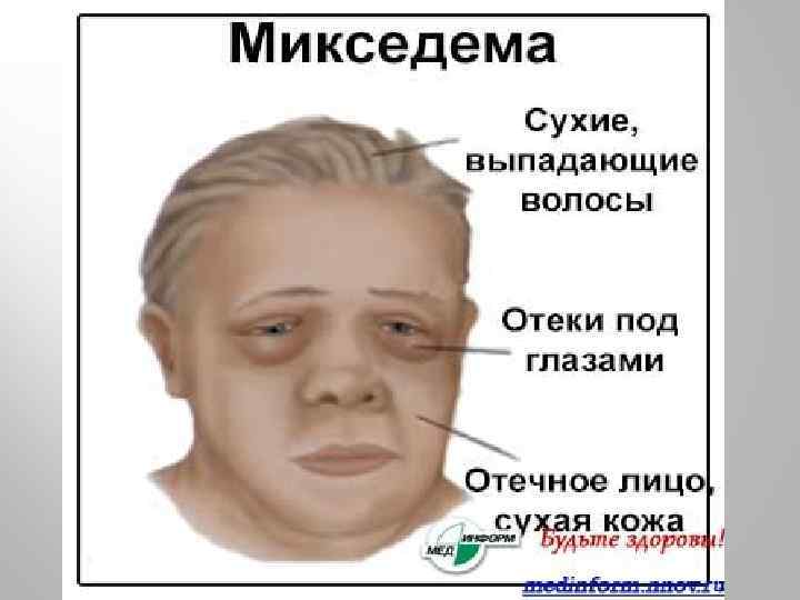 Микседема 