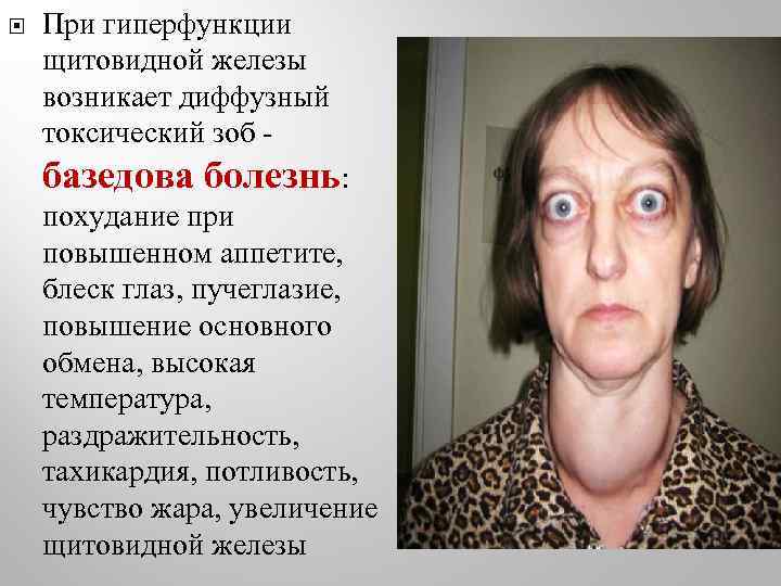  При гиперфункции щитовидной железы возникает диффузный токсический зоб - базедова болезнь: похудание при