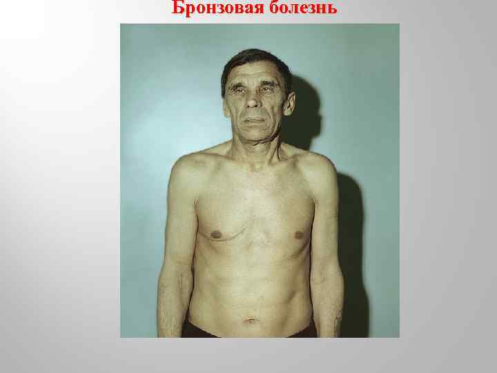 Бронзовая болезнь 