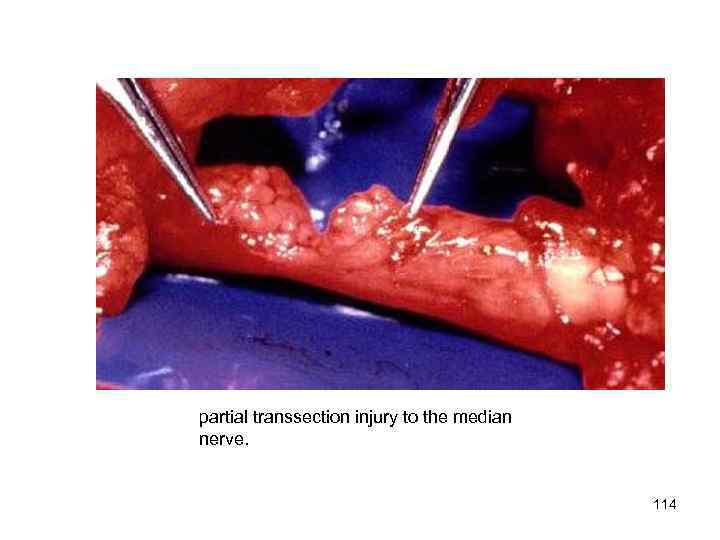 partial transsection injury to the median nerve. 114 