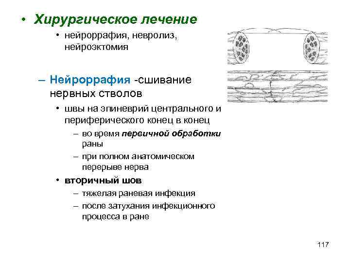  • Хирургическое лечение • нейроррафия, невролиз, нейроэктомия – Нейроррафия -сшивание нервных стволов •