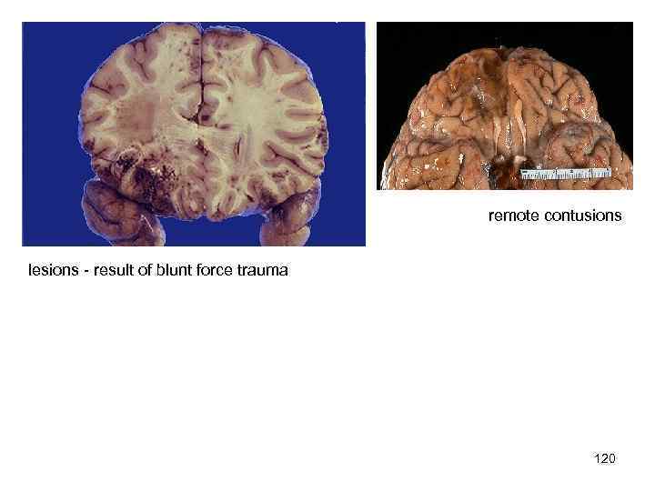 remote contusions lesions - result of blunt force trauma 120 