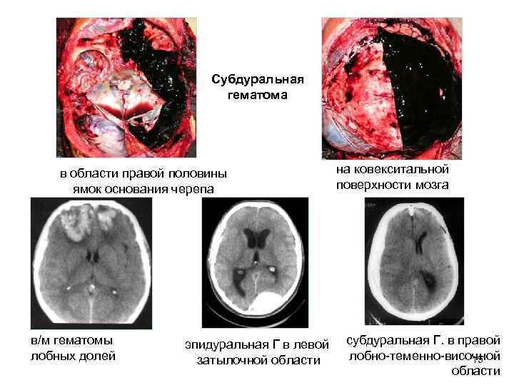 Субдуральная гематома в области правой половины ямок основания черепа в/м гематомы лобных долей эпидуральная
