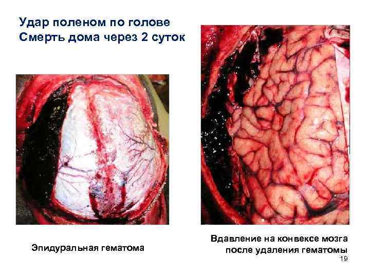 Удар поленом по голове Смерть дома через 2 суток Эпидуральная гематома Вдавление на конвексе