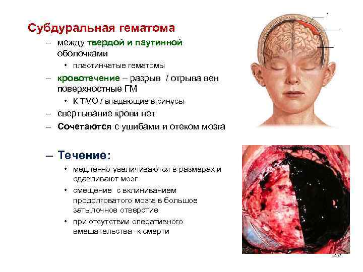 Субдуральная гематома – между твердой и паутинной оболочками • пластинчатые гематомы – кровотечение –