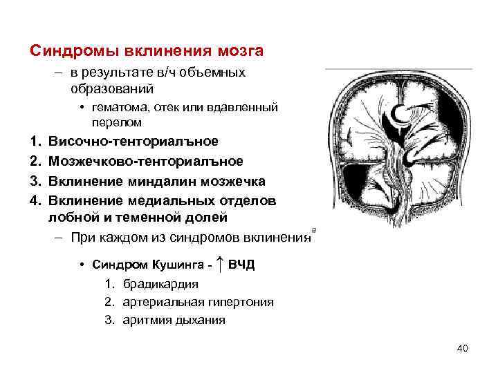 Дислокация мозгах