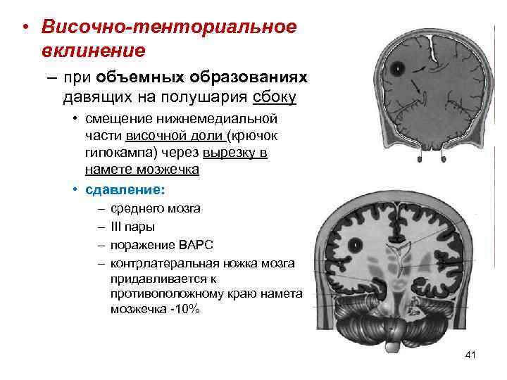  • Височно-тенториальное вклинение – при объемных образованиях давящих на полушария сбоку • смещение