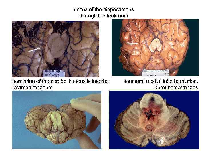 uncus of the hippocampus through the tentorium herniation of the cerebelllar tonsils into the