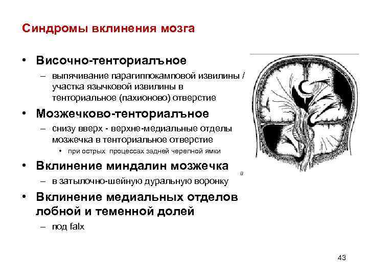 Дислокация мозгах