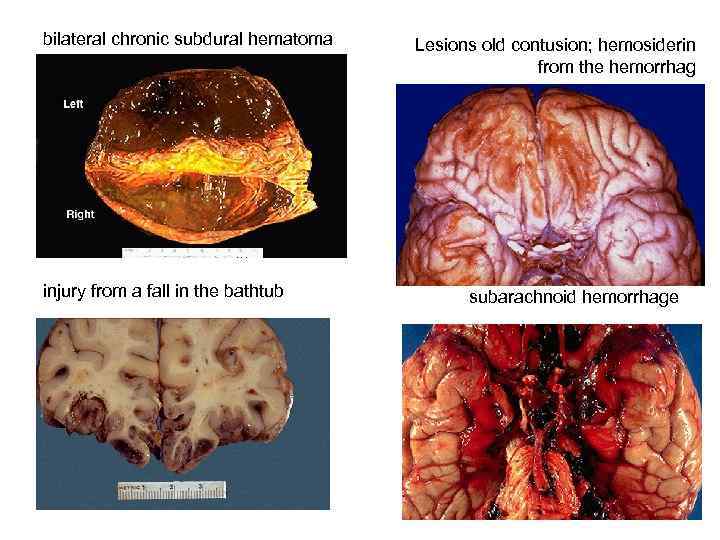 bilateral chronic subdural hematoma injury from a fall in the bathtub Lesions old contusion;