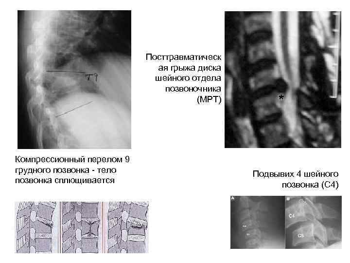 Посттравматическ ая грыжа диска шейного отдела позвоночника (МРТ) Компрессионный перелом 9 грудного позвонка -