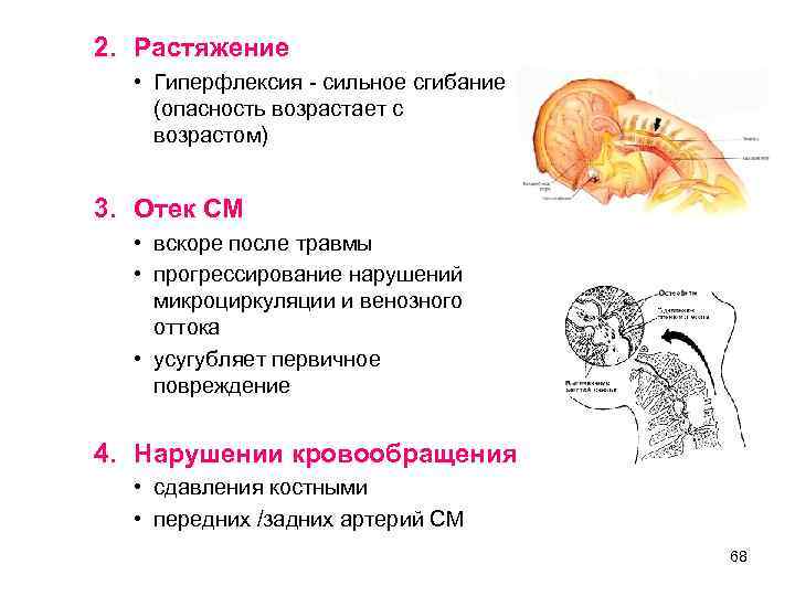 2. Растяжение • Гиперфлексия - сильное сгибание (опасность возрастает с возрастом) 3. Отек СМ