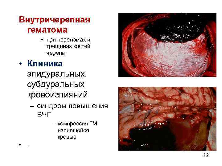 Внутричерепная гематома • при переломах и трещинах костей черепа • Клиника эпидуральных, субдуральных кровоизлияний