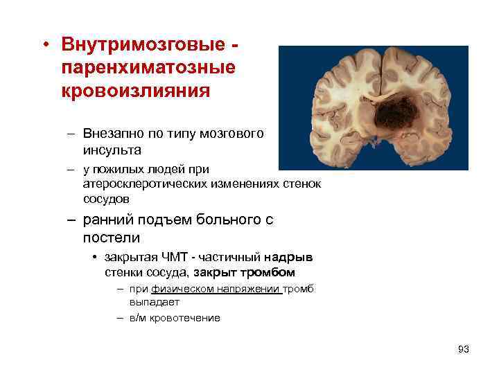  • Внутримозговые паренхиматозные кровоизлияния – Внезапно по типу мозгового инсульта – у пожилых