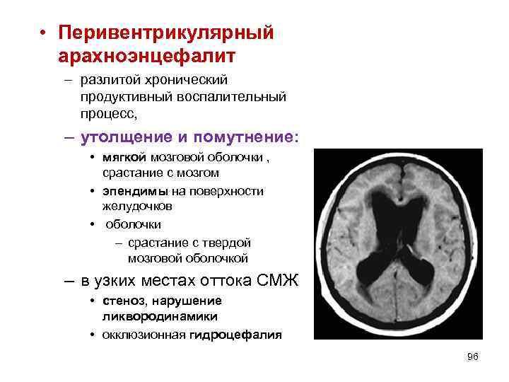  • Перивентрикулярный арахноэнцефалит – разлитой хронический продуктивный воспалительный процесс, – утолщение и помутнение: