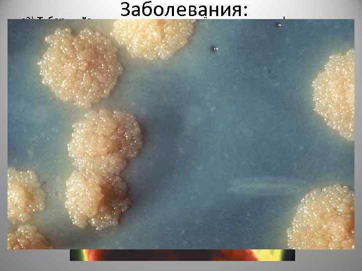 Заболевания: • 2) Туберкулёз— широко распространённое в мире инфекционное заболевание человека и животных, вызываемое