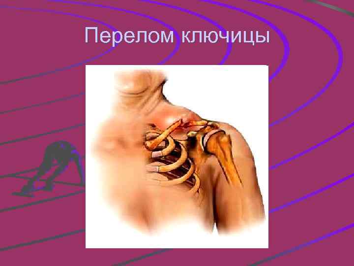 Перелом ключицы 