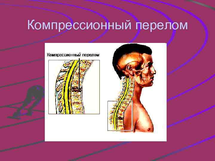 Компрессионный перелом карта вызова