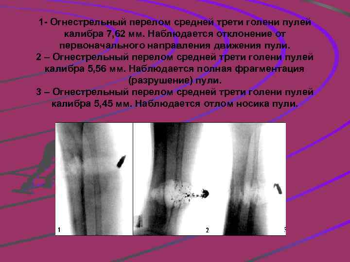 Дырчатый перелом. Огнестрельный перелом голени. Перелом при огнестрельном ранении. Огнестрельное ранение голени. Огнестрельный перелом рентген.