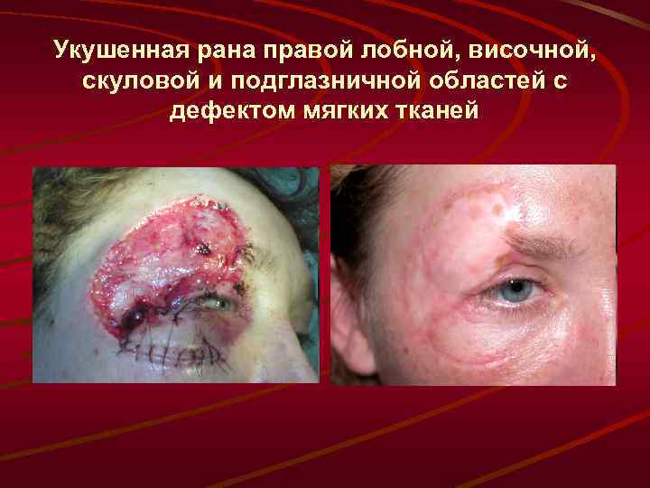 Укушенная рана правой лобной, височной, скуловой и подглазничной областей с дефектом мягких тканей 