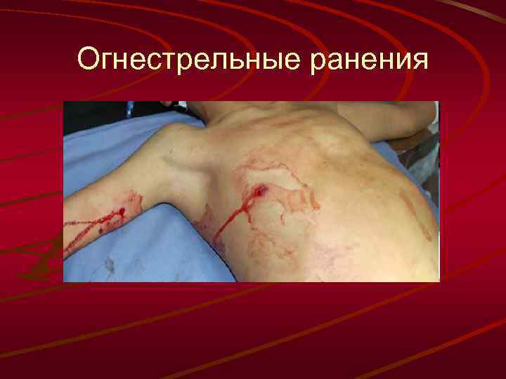 Огнестрельные ранения 