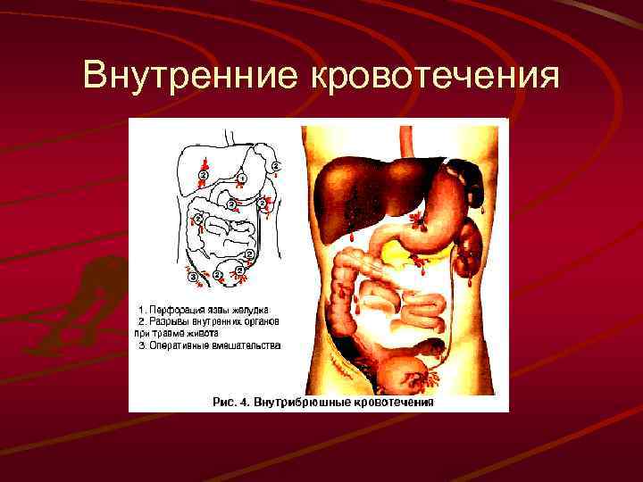 Внутренние кровотечения 