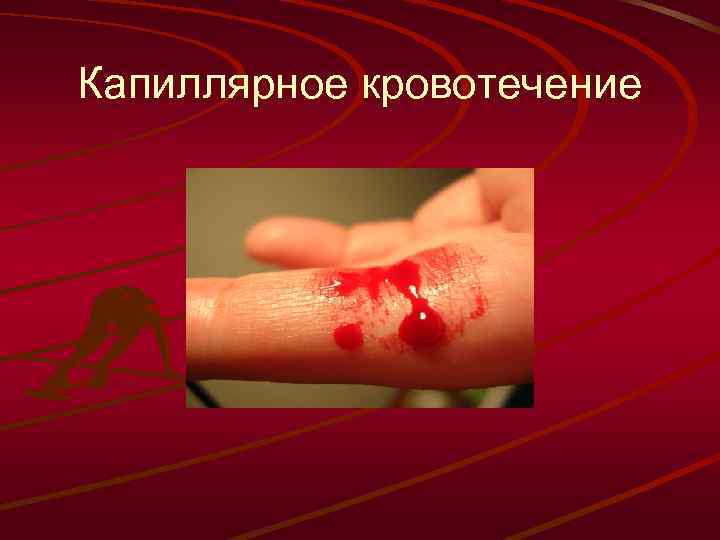 Капиллярное кровотечение 