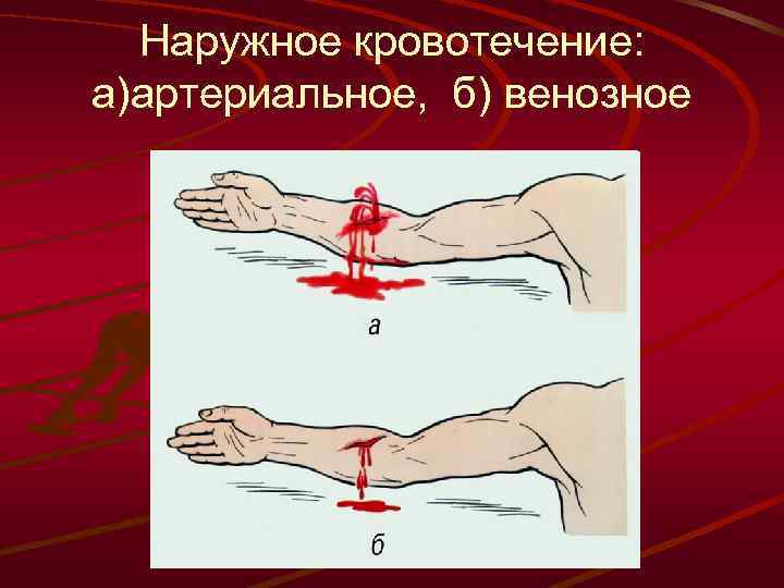 Наружное кровотечение: а)артериальное, б) венозное 