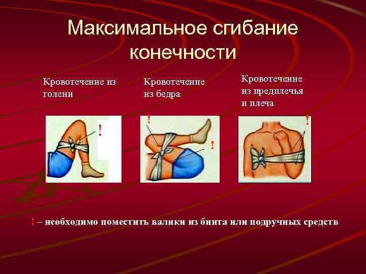 Кровотечение конечностей