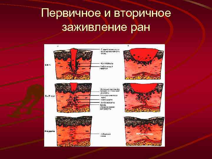 Первичное и вторичное заживление ран 
